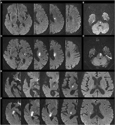 The neutrophil-to-lymphocyte ratio is an important indicator correlated to early neurological deterioration in single subcortical infarct patients with diabetes